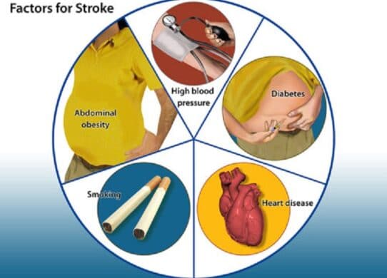 Stroke: Diabetes and Other Risk Factors !