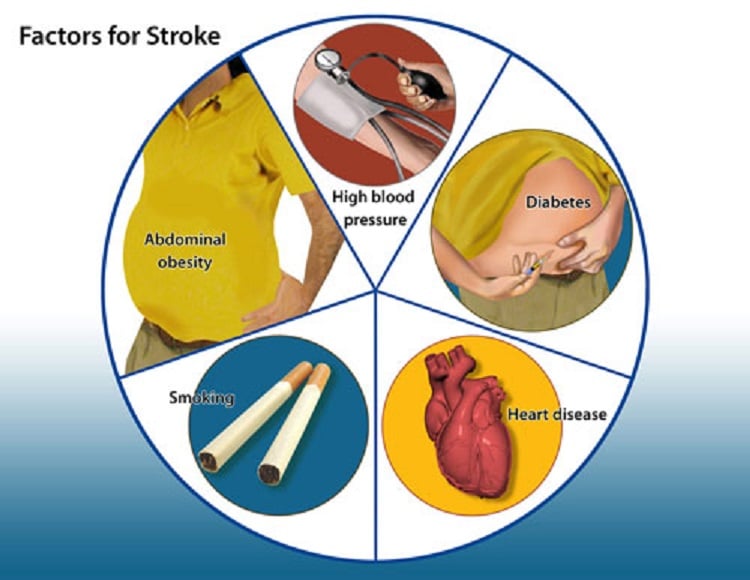 Stroke: Diabetes and Other Risk Factors !